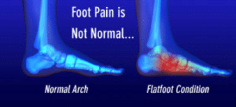 Flatfoot Condition Treatment Los Angeles
