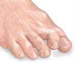 Hammer toe