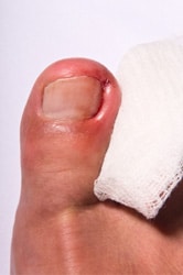 Ingrown Toenails