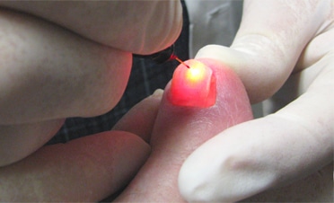 Laser Fungus