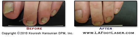 Toenail Fungus Before & After