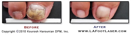 Toenail Fungus Before & After