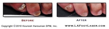 Toenail Fungus Before & After