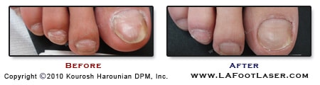 Toenail Fungus Before & After