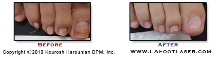 Toenail Fungus Before & After