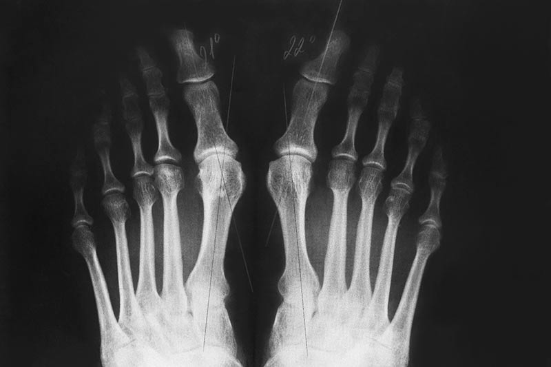 Bunion Xray Los Angeles