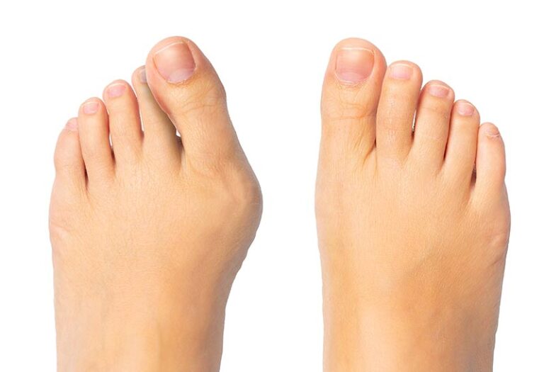 Bunion Treatment and Surgery Los Angeles LA Foot Laser