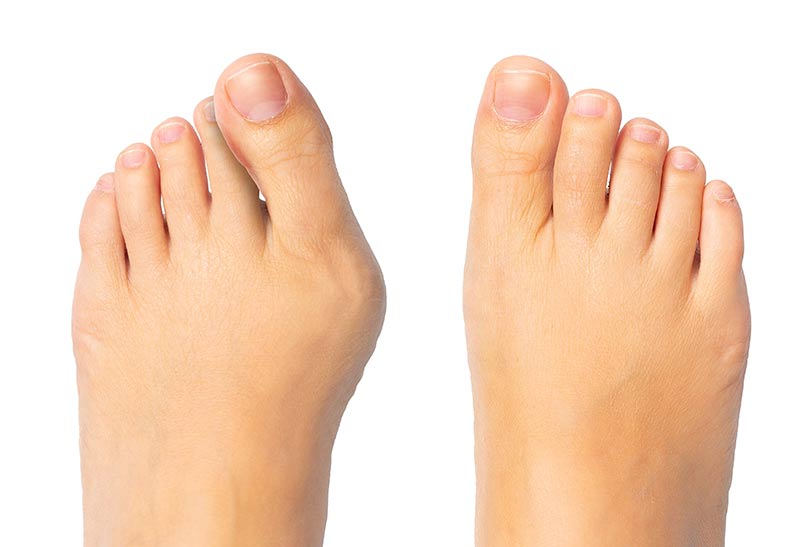 Bunion Treatment Los Angeles