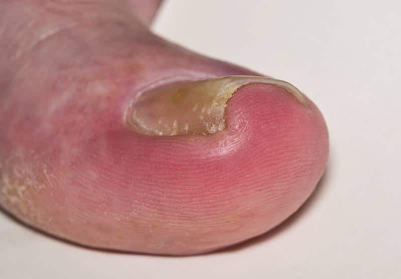 Ingrown Toenail Repair Los Angeles