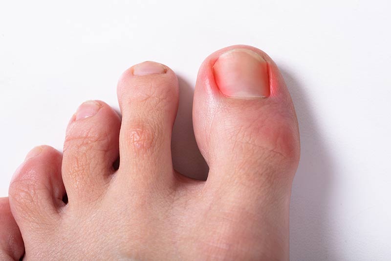 Ingrown Toenail Treatments, Surgical Removal