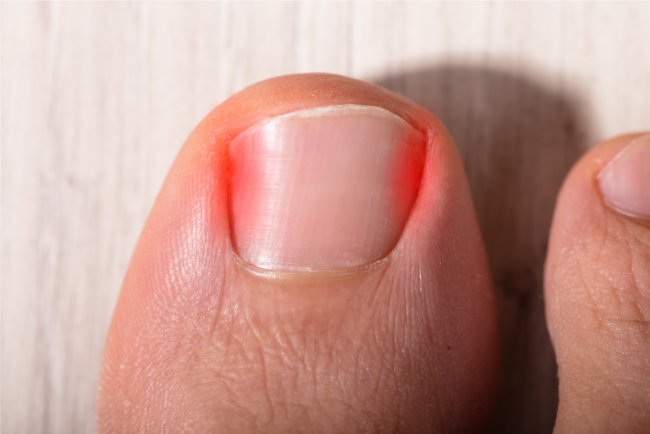 ingrown toenails