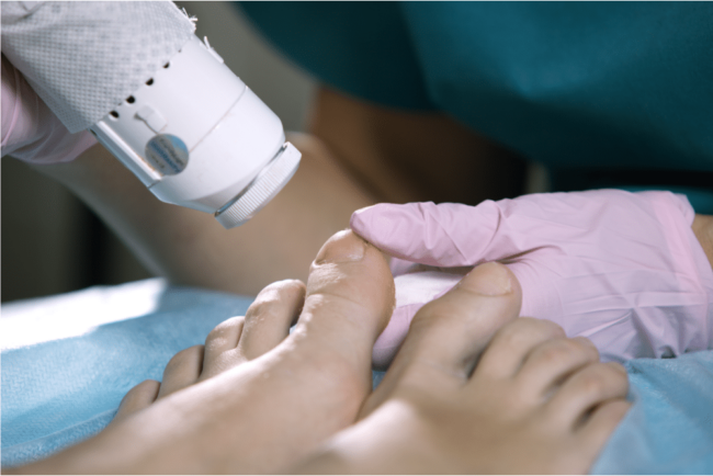 Toenail fungus laser treatment laser toenail fungus treatment