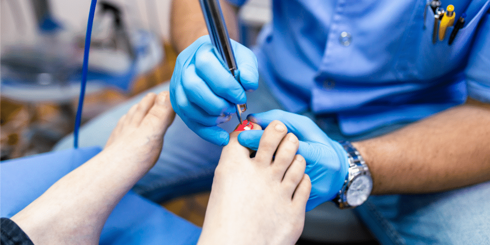 toenail fungus treatment toenail fungus treatment