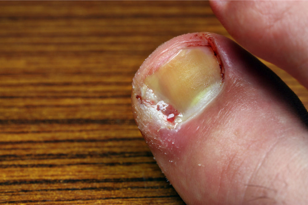 ingrown toenail ingrown toenail