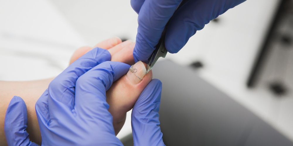 Ingrown Toenail Removal Los Angeles Ingrown Toenail Removal Los Angeles