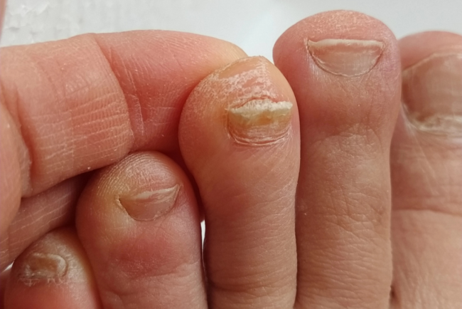 toenail fungus toenail fungus