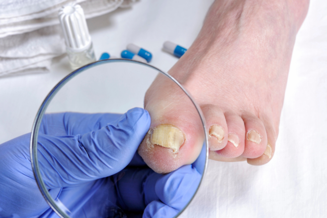 toenail fungus toenail fungus