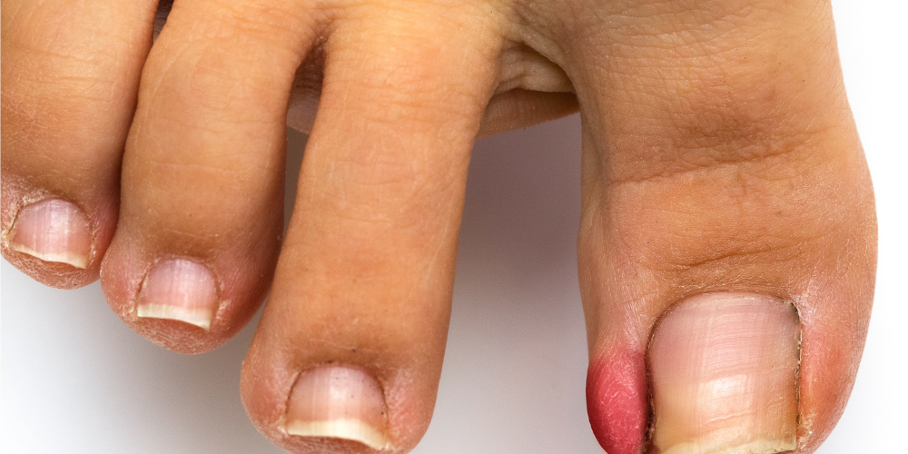 podiatrist at LA Foot, ingrown toenail