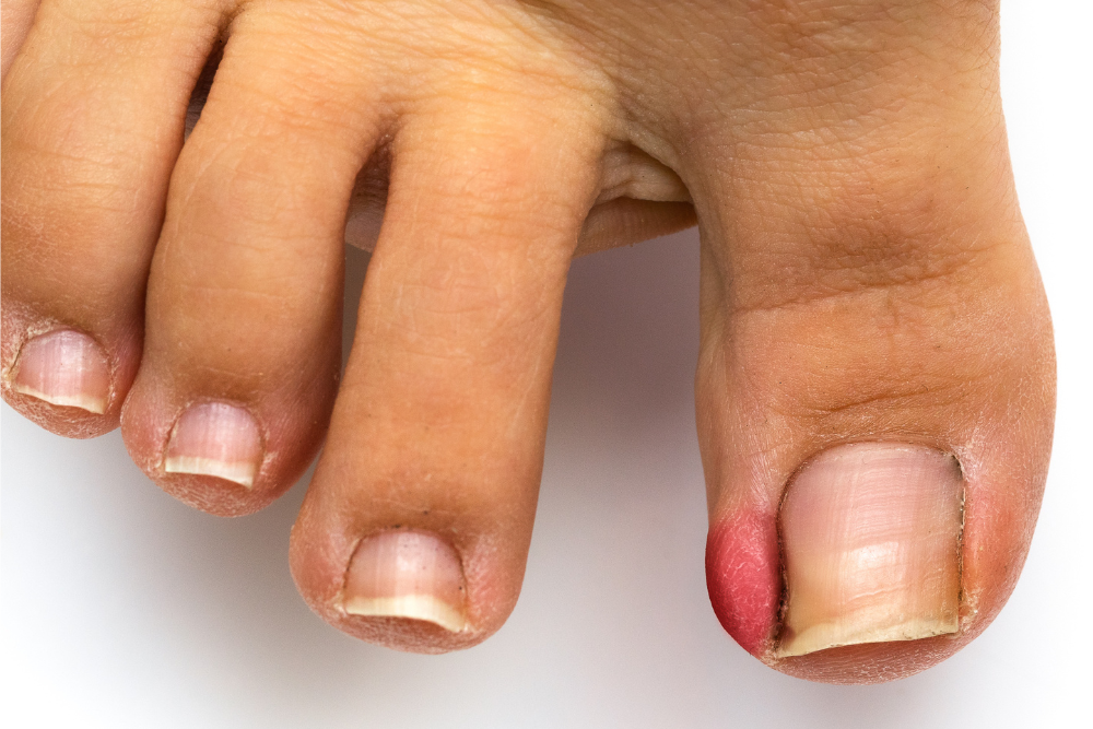 podiatrist at LA Foot, ingrown toenail