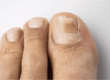 Laser toenail fungus treatment at LA Foot Laser in Los Angeles