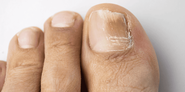 Laser toenail fungus treatment at LA Foot Laser in Los Angeles