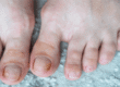 Podiatrist examining a patient's toenail for signs of fungal infection