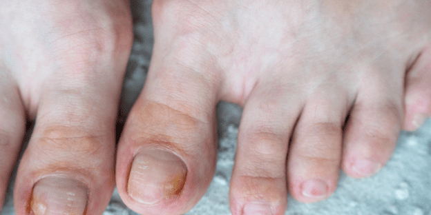 Podiatrist examining a patient's toenail for signs of fungal infection